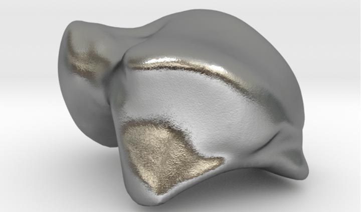اولین ایمپلنت استخوان تالوس پرینت سه بعدی
